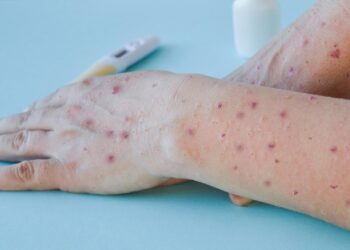 Seremi de Salud confirma primer caso de Mpox (ex viruela del mono) en Ñuble este 2025.