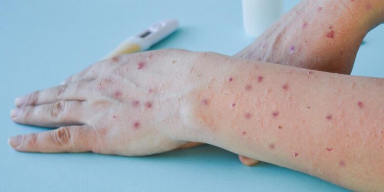 Seremi de Salud confirma primer caso de Mpox (ex viruela del mono) en Ñuble este 2025.