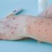 Seremi de Salud confirma primer caso de Mpox (ex viruela del mono) en Ñuble este 2025.