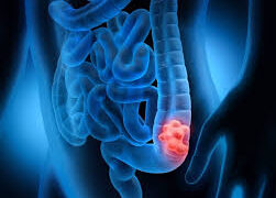 Mes del Cáncer de Colon: Alianza entre Clínica Universidad de los Andes y la Universidad de Kyoto para el avance en el tratamiento del cáncer de colon.