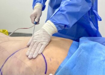 Clínica Andes Salud Chillán se posiciona como pionero en Ñuble al incorporar el PAD de Abdominoplastía.