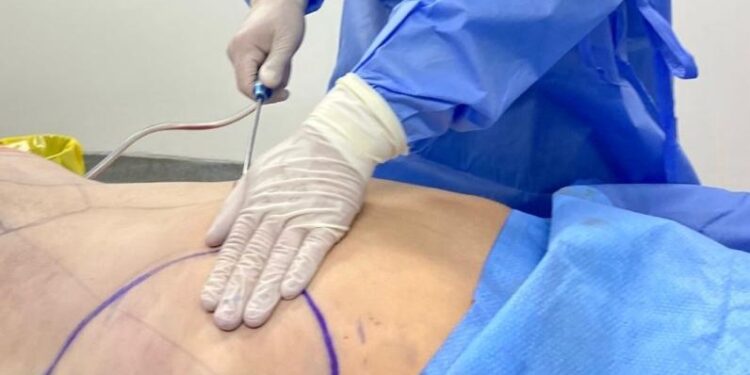 Clínica Andes Salud Chillán se posiciona como pionero en Ñuble al incorporar el PAD de Abdominoplastía.
