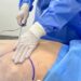 Clínica Andes Salud Chillán se posiciona como pionero en Ñuble al incorporar el PAD de Abdominoplastía.