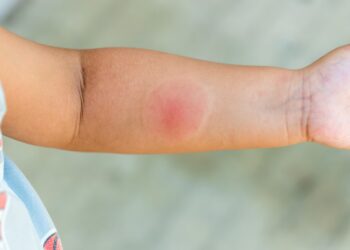 Servicio de Salud Ñuble refuerza llamado a prevenir picaduras e infecciones durante el verano.