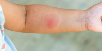Servicio de Salud Ñuble refuerza llamado a prevenir picaduras e infecciones durante el verano.