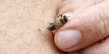 Picaduras de abeja: una reacción que puede transformarse en una urgencia vital.